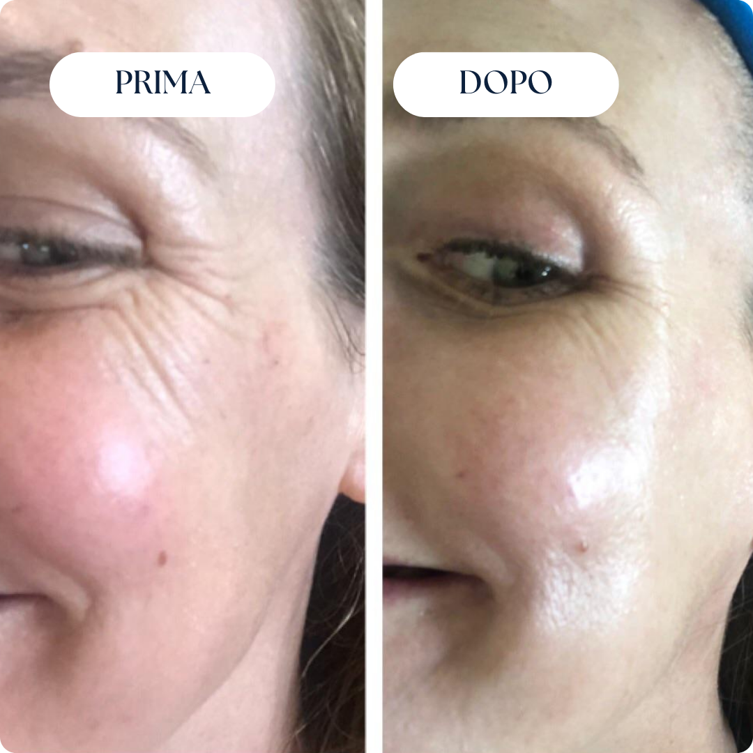 Nairè™ Micro-Needling Vitamina C Stabilizzata