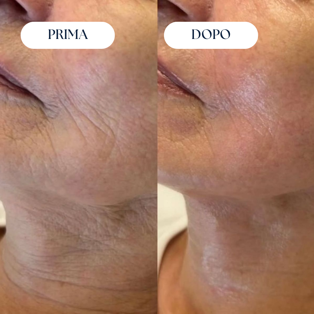 Nairè™ Micro-Needling Esosomi Vegetali