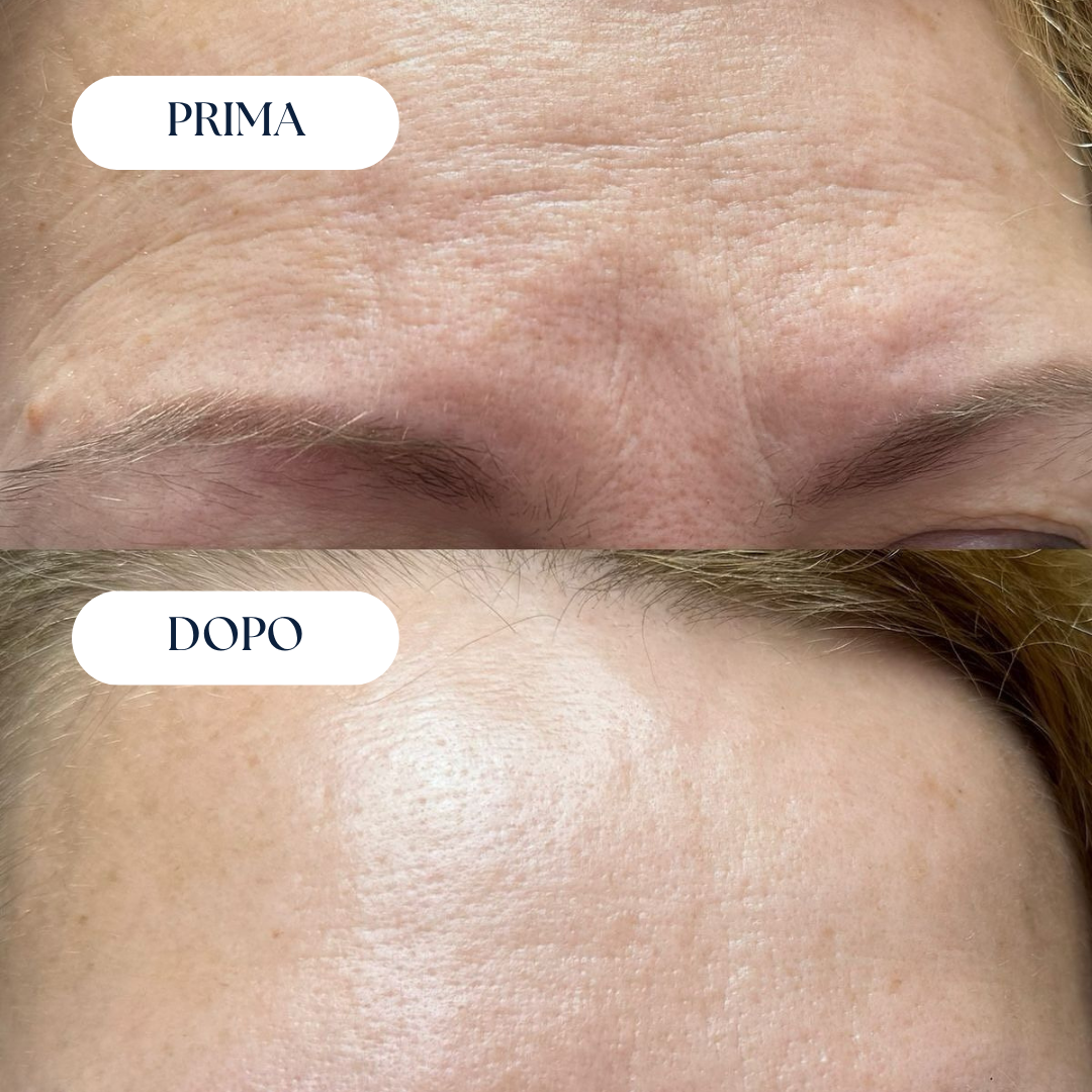 Nairè™ Micro-Needling Esosomi Vegetali