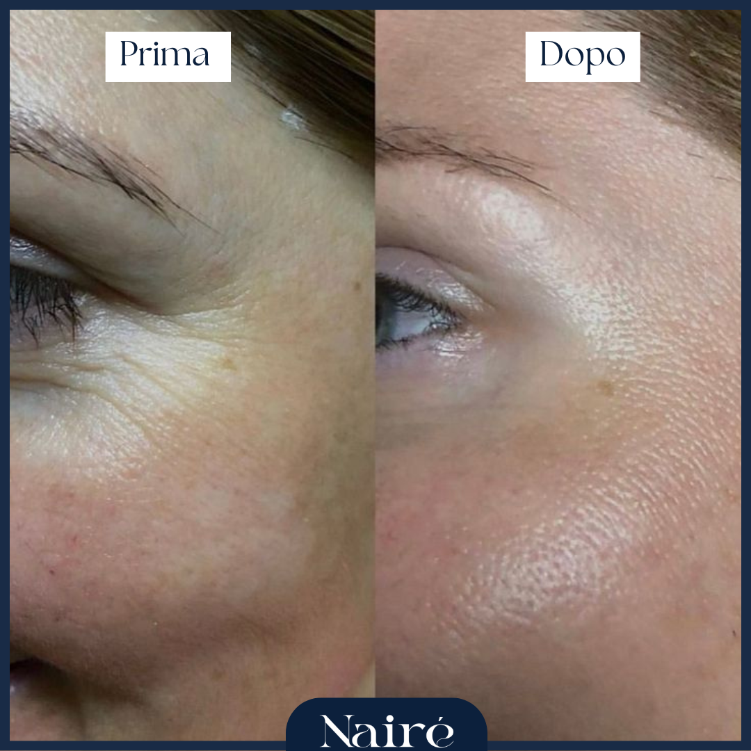 Nairè™ Micro-Needling Vitamina C Stabilizzata