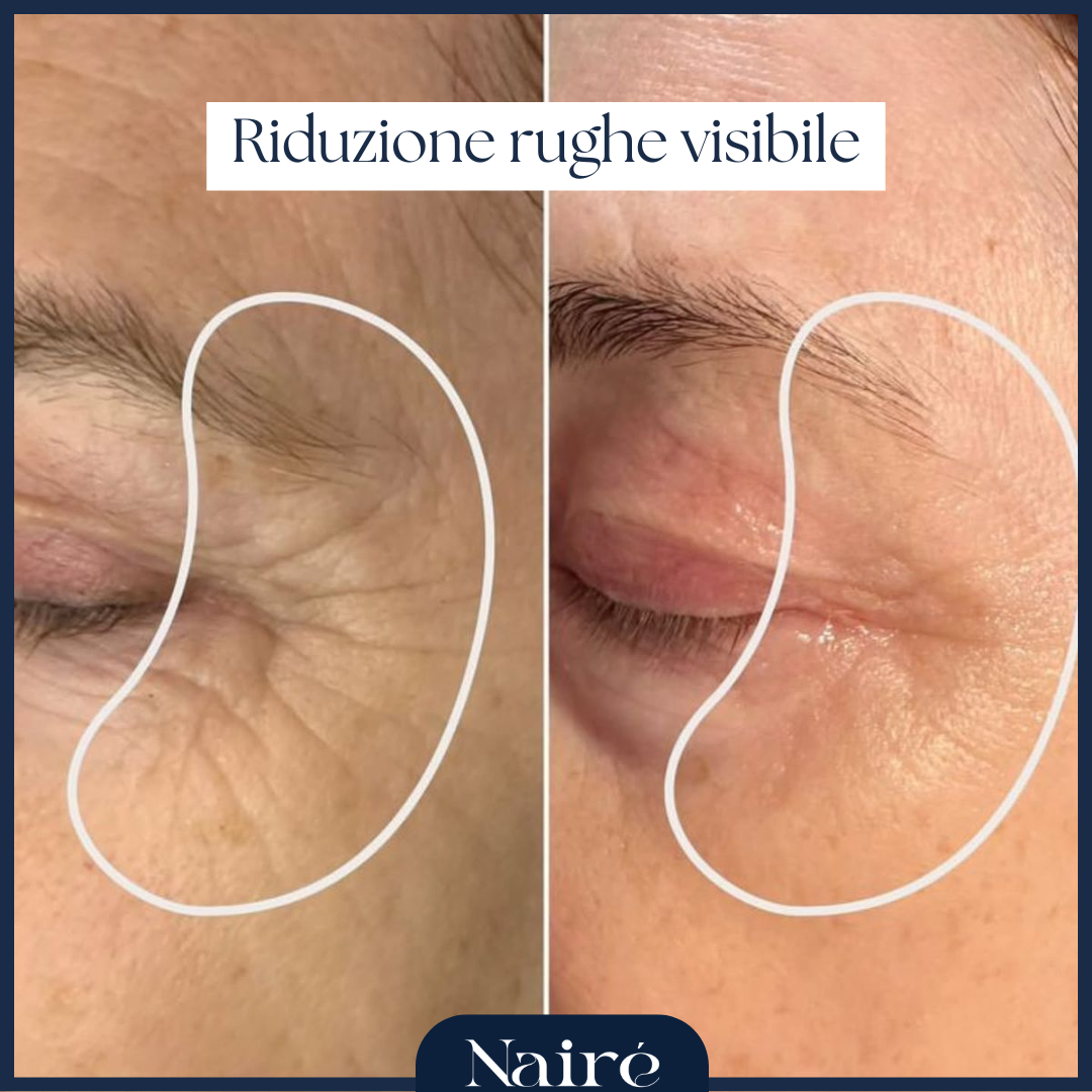 Nairè™ Micro-Needling Vitamina C Stabilizzata