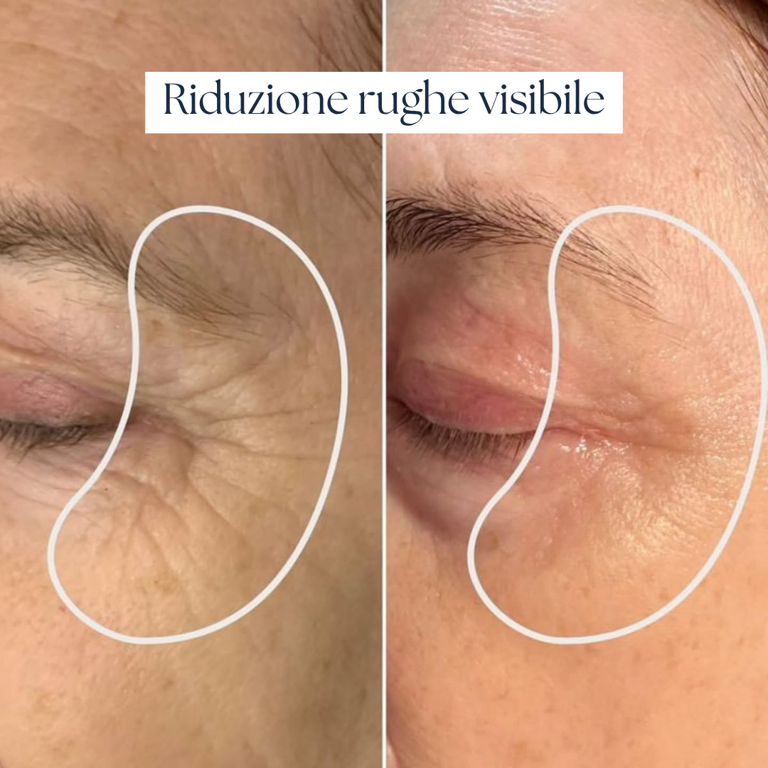 Nairè™ Micro-Needling Vitamina C Stabilizzata