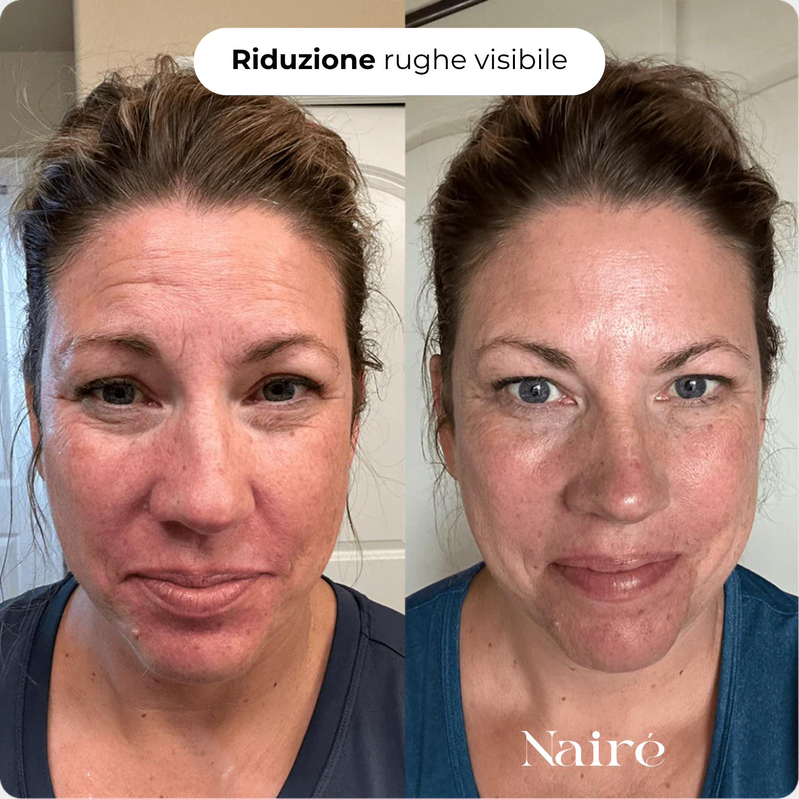 Nairè™ Micro-Needling Esosomi Vegetali