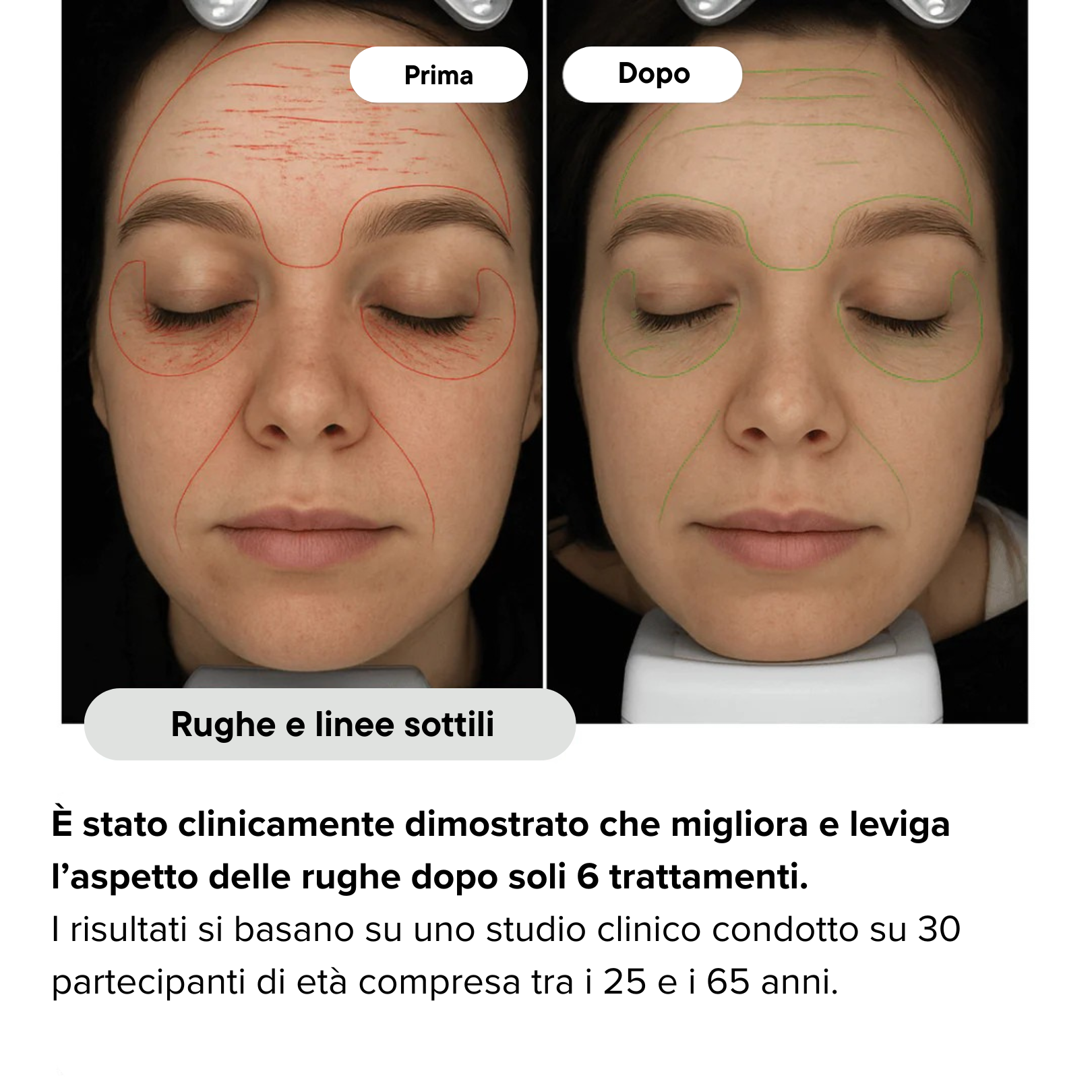 Nairè™ Micro-Needling Esosomi Vegetali