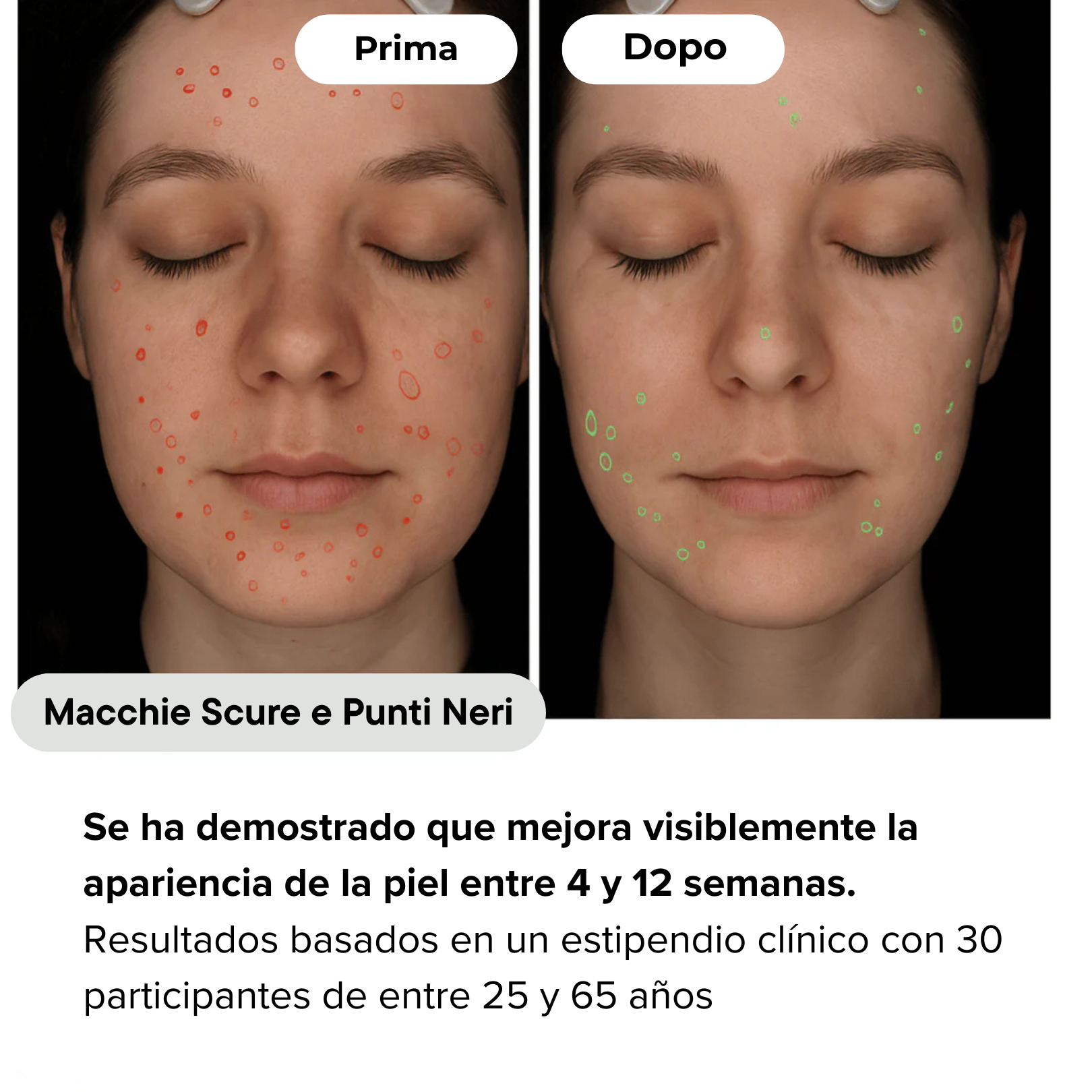 Nairè™ Micro-Needling Esosomi Vegetali