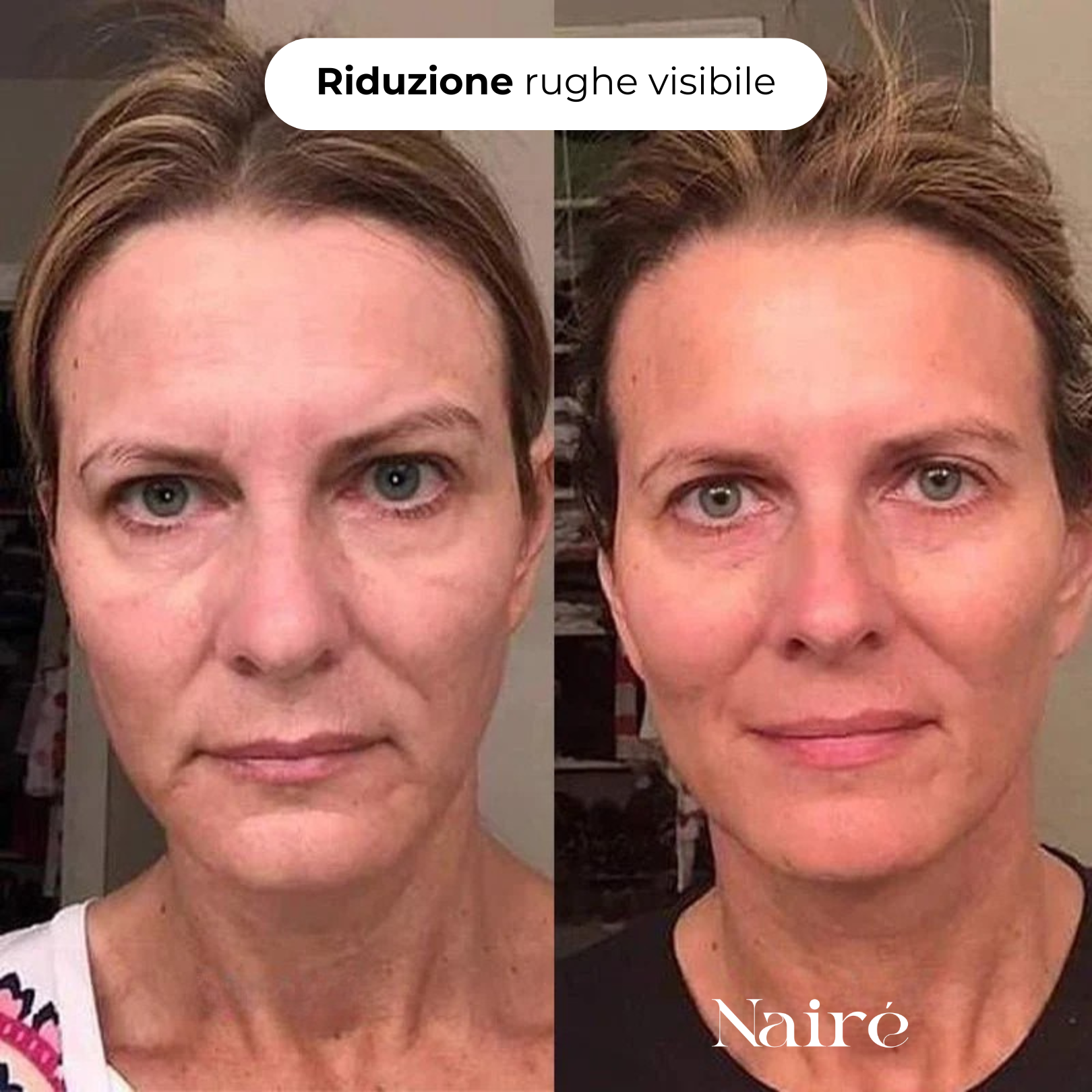 Nairè™ Micro-Needling Vitamina C Stabilizzata